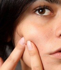 Treatments for Acne, Spots and Pimples