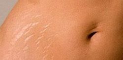Popular Remedies for Stretch Marks