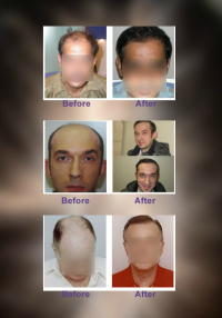 Hair Transplants