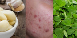10 Amazing Remedies for Acne Skin Problems