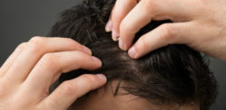 Popular Hair Loss Treatments for Men