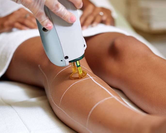 Is Laser Hair Removal Worth it for Asian Hair - procedure copy