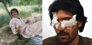 Pakistani Man Blinded by Father & Brothers in 'Honour Crime' f