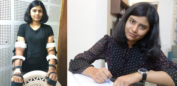 Indian Woman's Transplanted Hands now Match Her Skin f