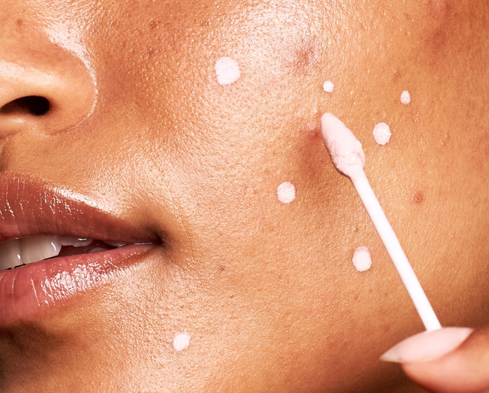 10 Best Skincare Tips for Brown Girls - spot treatment