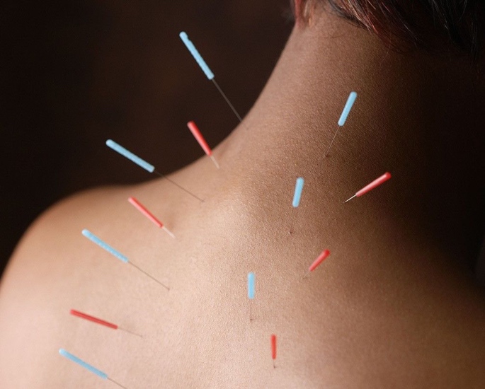 Tips for South Asian Women with PCOS - Acupuncture