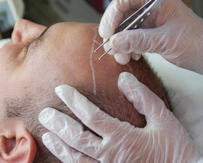 10 Hair Loss Remedies to Try for Desi Men - transplant