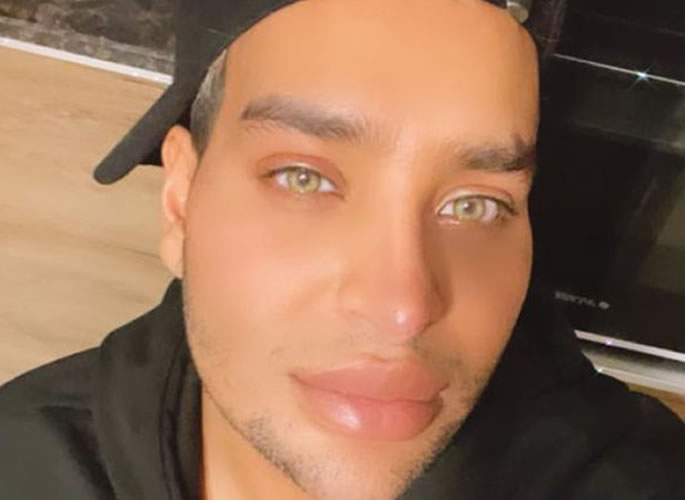 Man spends £130k on Cosmetic Surgery to Look like Filter