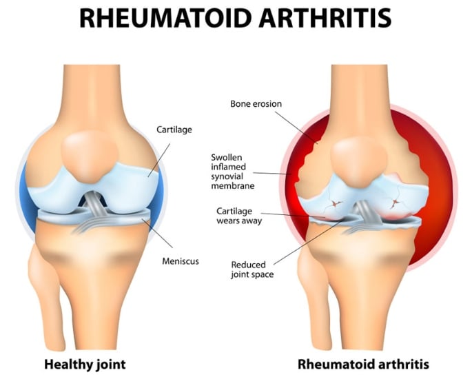 Desi Women's Experiences of Arthritis 