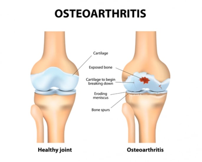 Desi Women's Experiences of Arthritis