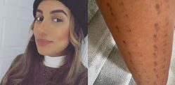 Woman left with 'Train Track' burns after Laser Hair Removal f