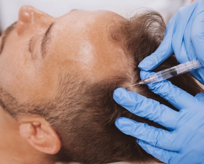 10 Best Ways to Reduce Hair Loss in Men