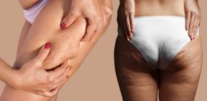 Which Treatments can help Reduce Cellulite - F