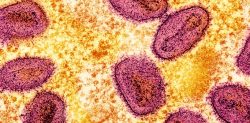Mpox Case in Pakistan as Fears Rise over Global Spread
