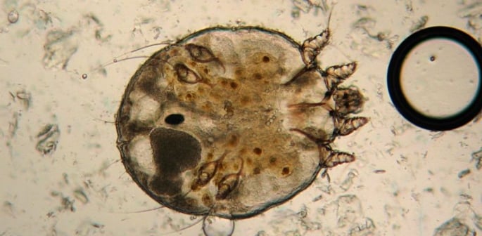 UK Outbreak of Scabies Sparks Urgent Warnings