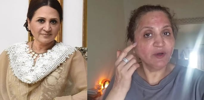 Asma Abbas suffers Post-Treatment Skin Allergy f