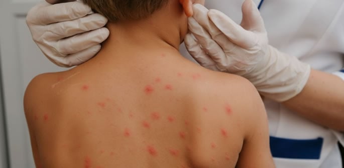 Children to be Offered Free Chickenpox Vaccine on NHS f