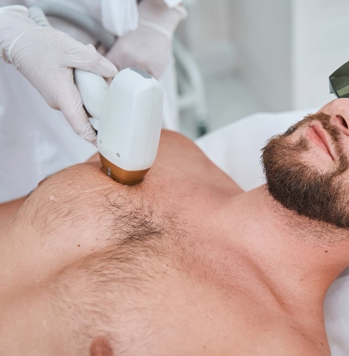 Why More Men are Turning to Laser Hair Removal 