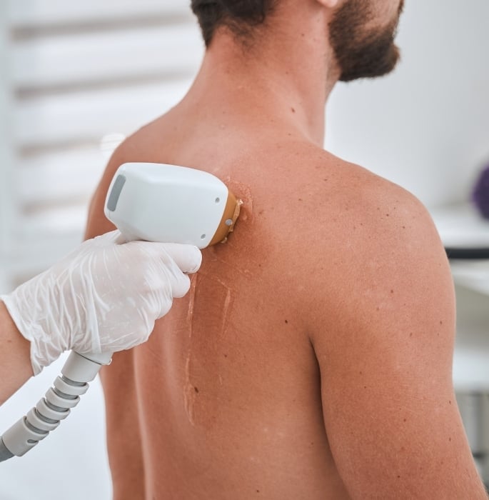 Why More Men are Turning to Laser Hair Removal 