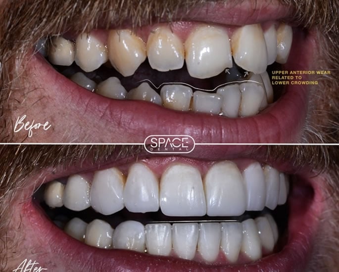 Dr Affan Saghir breaks down 'Turkey Teeth' Trend & Cosmetic Myths 3