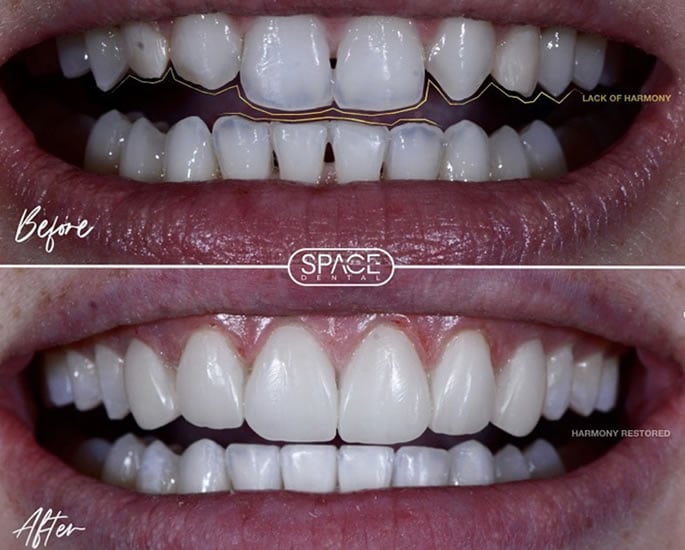 Dr Affan Saghir breaks down 'Turkey Teeth' Trend & Cosmetic Myths
