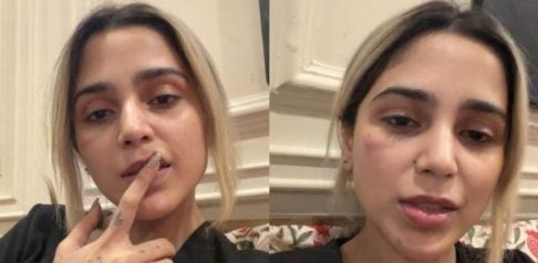 Aima Baig's Bruise Sparks Domestic Violence Rumours f